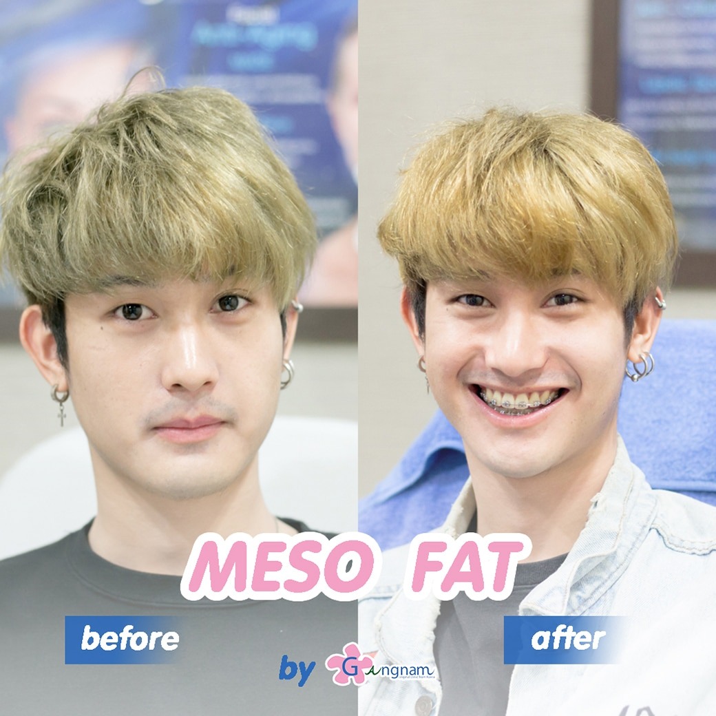 ฉีด meso fat