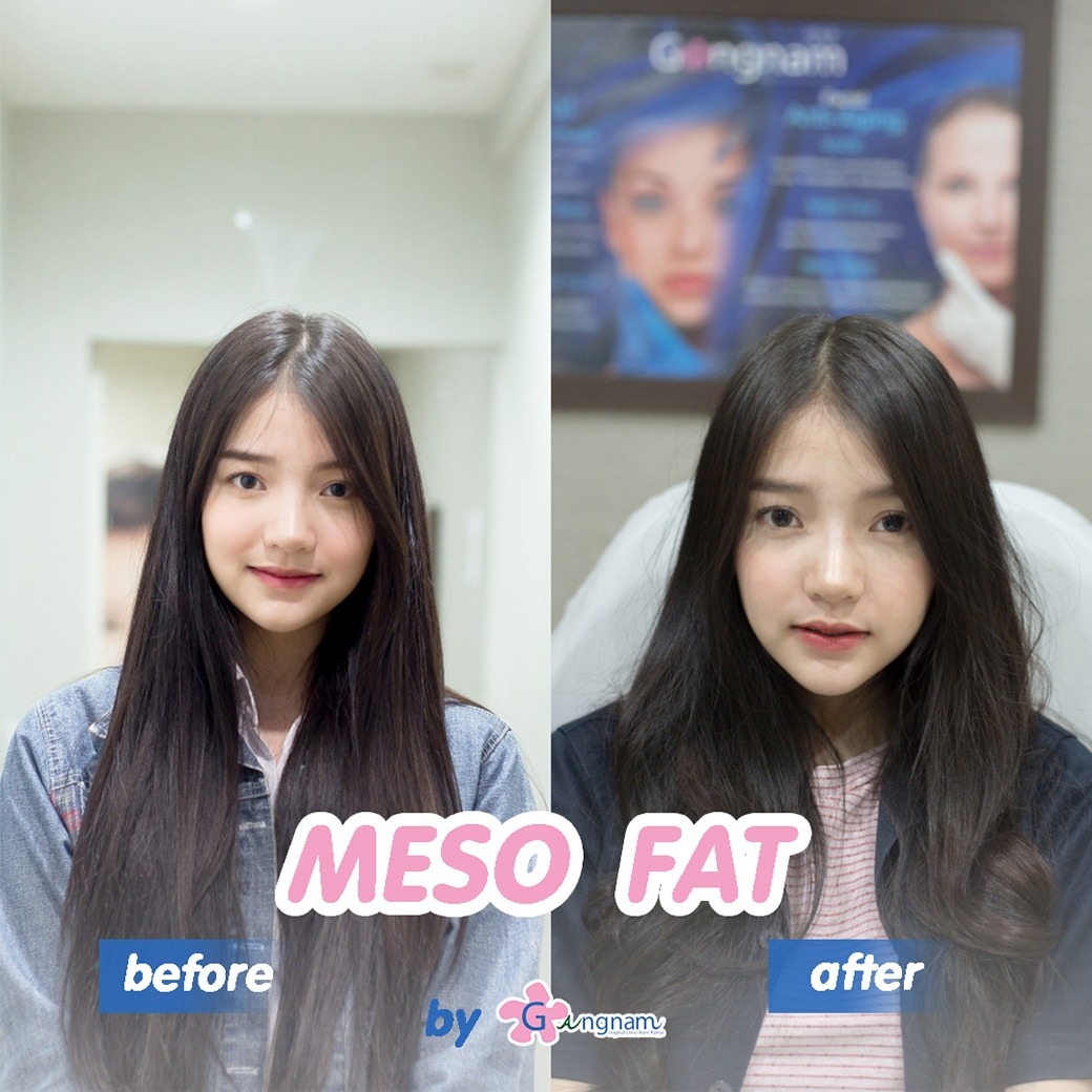 meso fat รีวิว