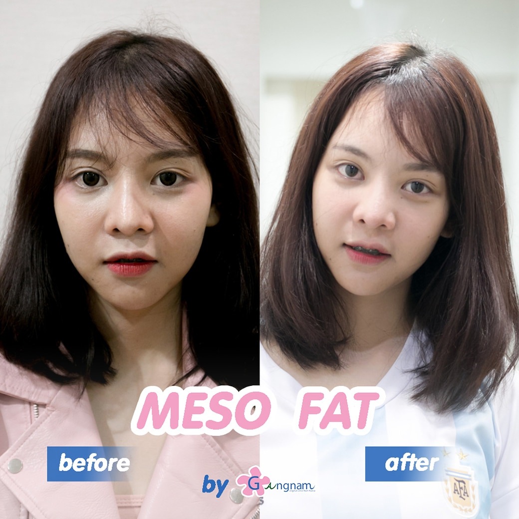 meso fat ที่ไหนดี