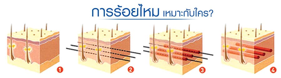 ร้อยไหม