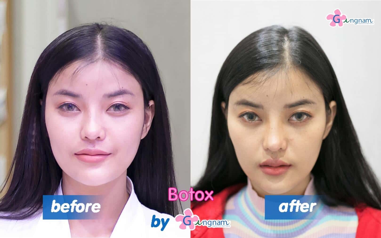 ฉีดโบท็อก botox น้องฝ้าย-2