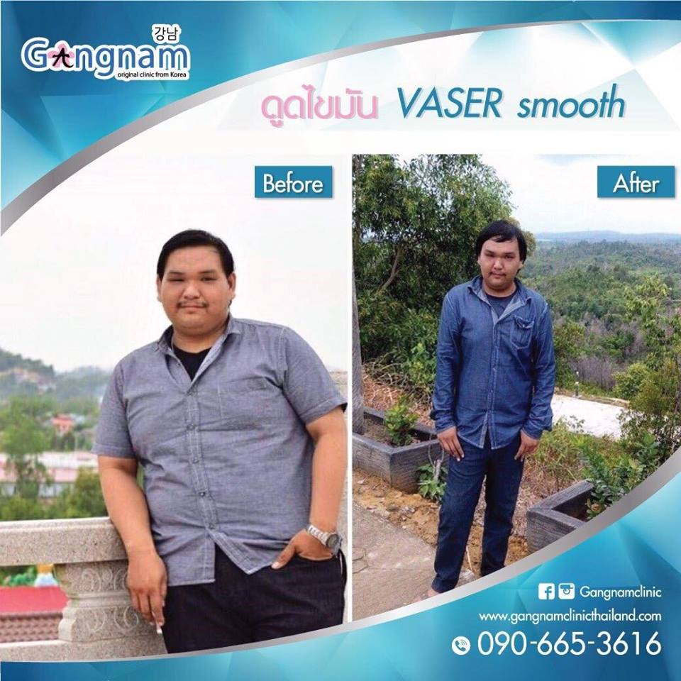 ดูดไขมันต้นแขน ,ดูดไขมันที่ไหนดีที่สุด ,ดูดไขมันต้นขา ,ดูดไขมันแก้ม ,เวเซอร์ต้นขา ,ดูดไขมัน vaser ,ลดไขมันเฉพาะส่วน ,สลายไขมันหน้าท้อง ,vaser liposelection ,ดูดไขมันทั้งตัว ราคา ,ดูดไขมันหน้าท้องที่ไหนดี ,ดูดไขมันราคาเท่าไหร่ ,เวเซอร์ ,vaser ดูดไขมัน ,vaser ,ทํา vaser ที่ไหนดี ,ดูดไขมันโปรโมชั่น ,รีวิว vaser ,vaser ต้นขา ,สลายไขมันต้นขา ,ลดไขมันต้นขา ,ดูดไขมันต้นขา ราคา ,ดูดไขมันยันฮี ราคา ,ดูดไขมัน ราคายันฮี ,ดูดไขมันหน้าท้อง ,vaser แขน ,ดูดไขมันต้นขา ,ดูดไขมันหน้าท้อง ราคา ,ดูดไขมันต้นแขน ราคา ,ดูดไขมัน ยันฮี ,bodytite ราคา ,ดูดไขมัน รีวิว ,เวเซอร์ต้นแขน ,ดูดไขมันที่ไหนดี ,เวเซอร์ต้นแขน ,ดูดไขมัน ราคาถูก ,vaser รีวิว ,ราคา ดูดไขมัน ,ราคา ดูดไขมันต้นขา ,ดูดไขมัน ราคา ,ดูดไขมันแบบใหม่ ,ดูดไขมันน่อง ,ดูดไขมันที่ไหนดี ,ดูดไขมันขา ,ดูดไขมัน vaser ราคา ,โปรโมชั่นดูดไขมัน ,ดูดไขมันใต้คาง ,vaser ขา ,vaser ราคา ,vaser ที่ไหนดี ,ดูดไขมัน pantip ,ราคา ดูดไขมันหน้าท้อง ดูดไขมันต้นแขน ,ดูดไขมันที่ไหนดีที่สุด ,ดูดไขมันต้นขา ,ดูดไขมันแก้ม ,เวเซอร์ต้นขา ,ดูดไขมัน vaser ,ลดไขมันเฉพาะส่วน ,สลายไขมันหน้าท้อง ,vaser liposelection ,ดูดไขมันทั้งตัว ราคา ,ดูดไขมันหน้าท้องที่ไหนดี ,ดูดไขมันราคาเท่าไหร่ ,เวเซอร์ ,vaser ดูดไขมัน ,vaser ,ทํา vaser ที่ไหนดี ,ดูดไขมันโปรโมชั่น ,รีวิว vaser ,vaser ต้นขา ,สลายไขมันต้นขา ,ลดไขมันต้นขา ,ดูดไขมันต้นขา ราคา ,ดูดไขมันยันฮี ราคา ,ดูดไขมัน ราคายันฮี ,ดูดไขมันหน้าท้อง ,vaser แขน ,ดูดไขมันต้นขา ,ดูดไขมันหน้าท้อง ราคา ,ดูดไขมันต้นแขน ราคา ,ดูดไขมัน ยันฮี ,bodytite ราคา ,ดูดไขมัน รีวิว ,เวเซอร์ต้นแขน ,ดูดไขมันที่ไหนดี ,เวเซอร์ต้นแขน ,ดูดไขมัน ราคาถูก ,vaser รีวิว ,ราคา ดูดไขมัน ,ราคา ดูดไขมันต้นขา ,ดูดไขมัน ราคา ,ดูดไขมันแบบใหม่ ,ดูดไขมันน่อง ,ดูดไขมันที่ไหนดี ,ดูดไขมันขา ,ดูดไขมัน vaser ราคา ,โปรโมชั่นดูดไขมัน ,ดูดไขมันใต้คาง ,vaser ขา ,vaser ราคา ,vaser ที่ไหนดี ,ดูดไขมัน pantip ,ราคา ดูดไขมันหน้าท้อง