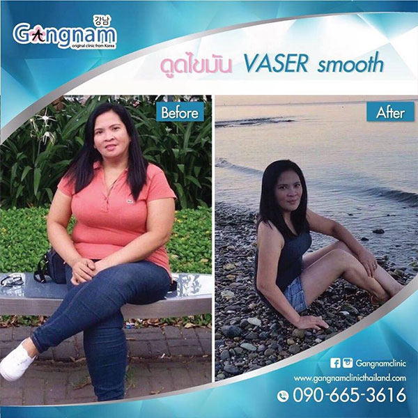 ดูดไขมัน-vaser-smooth