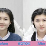 รีวิว โบท็อก พร้อมข้อควรระวังที่สาว ๆ ไม่ควรพลาด