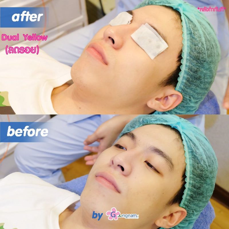 Dual-laser-หน้าใสเหมาะกับใคร-